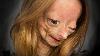 Adalia Rose Youtube Star With Rare Disorder Dead At 15